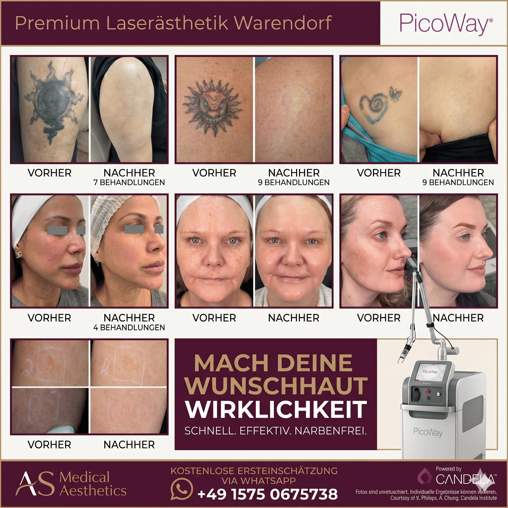 Professionelle PicoWay Laserbehandlung und Tattooentfernung für Patienten aus Bielefeld und Ostwestfalen-Lippe