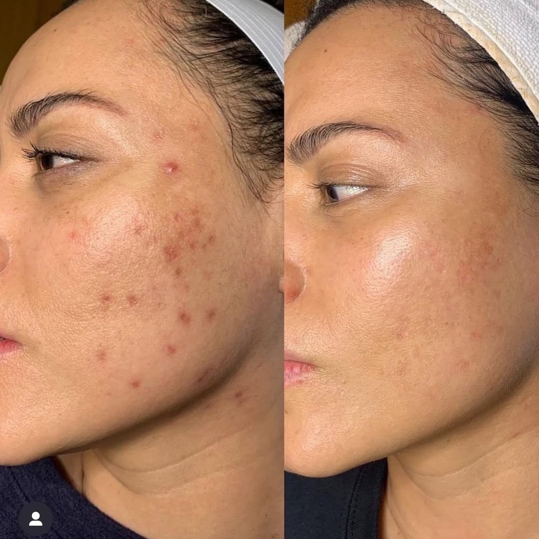 Microneedling pore refinement Münster Warendorf