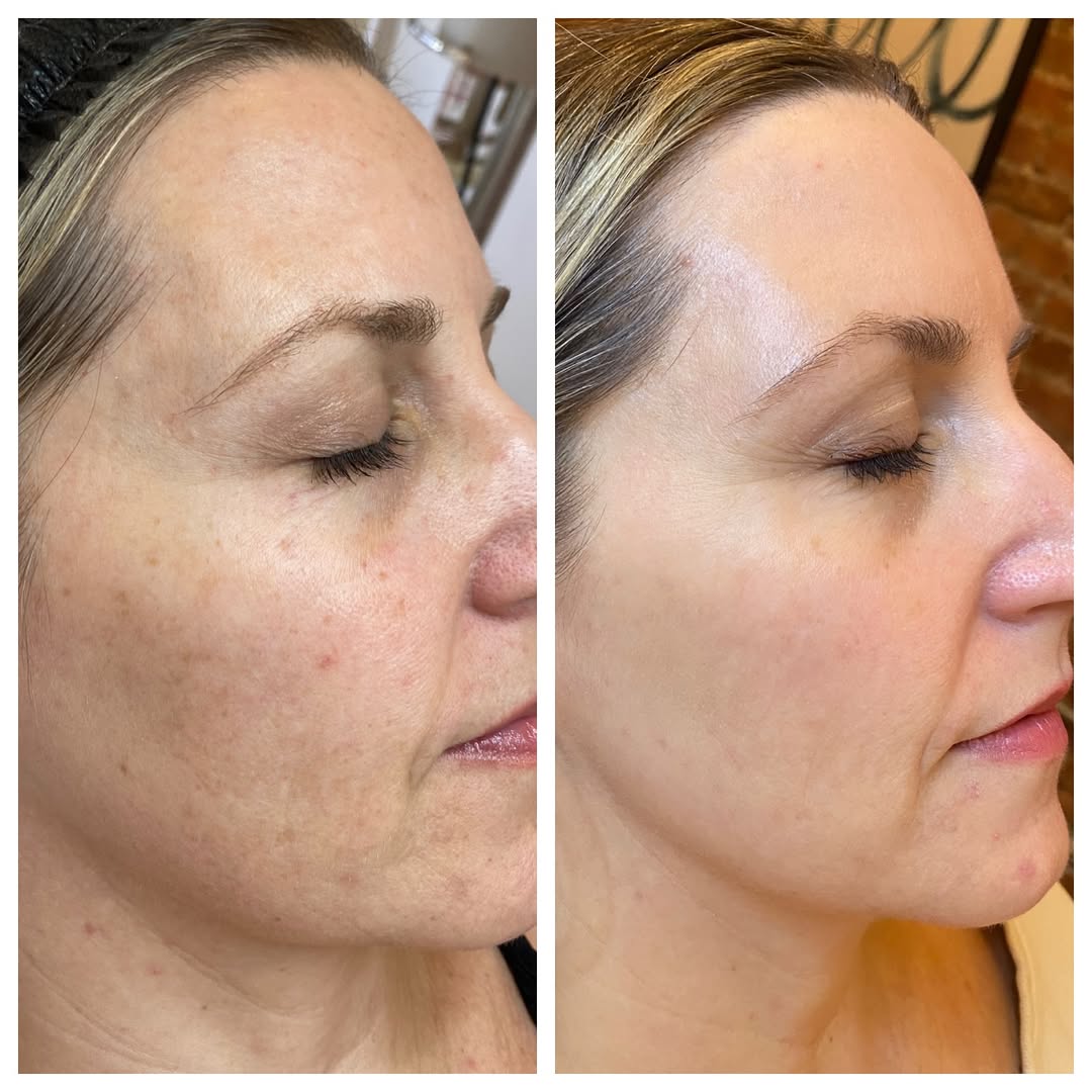 SkinPen microneedling before and after in Warendorf for Münster and surrounding areas
