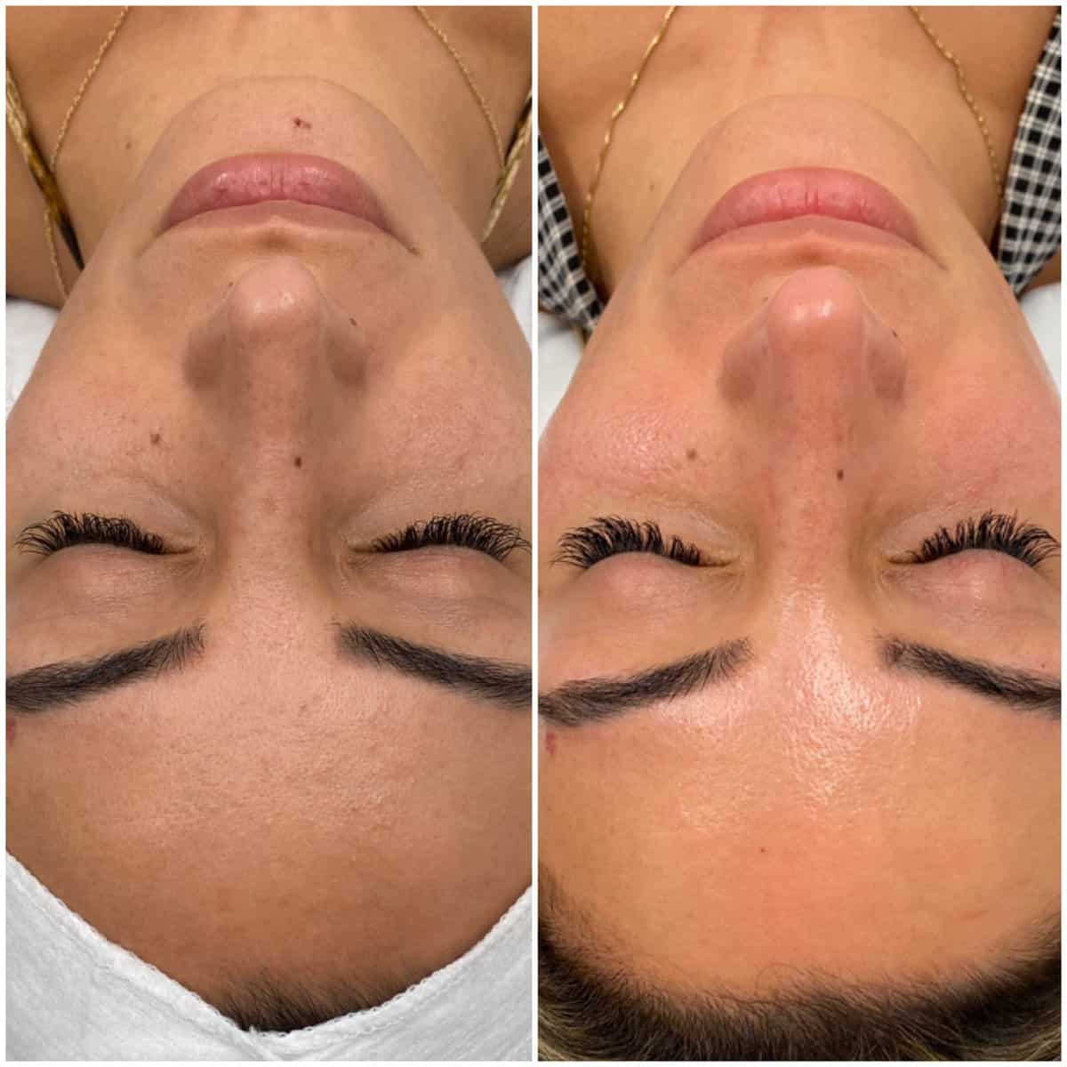 SkinPen microneedling for wrinkles and skin renewal Münster