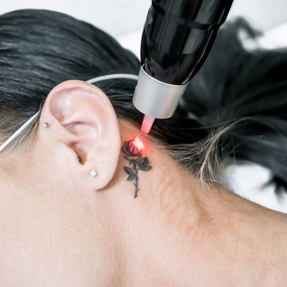 Tattooentfernung Warendorf Münsterland PicoWay Laser