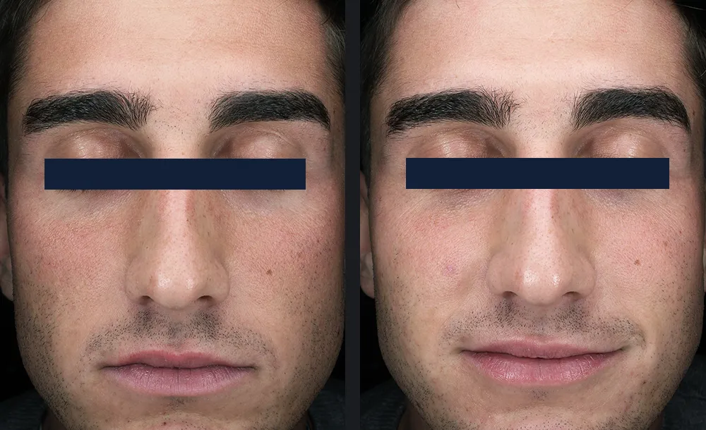 Glacé Hydrodermabrasion Tiefenreinigung Vorher-Nachher Ergebnis