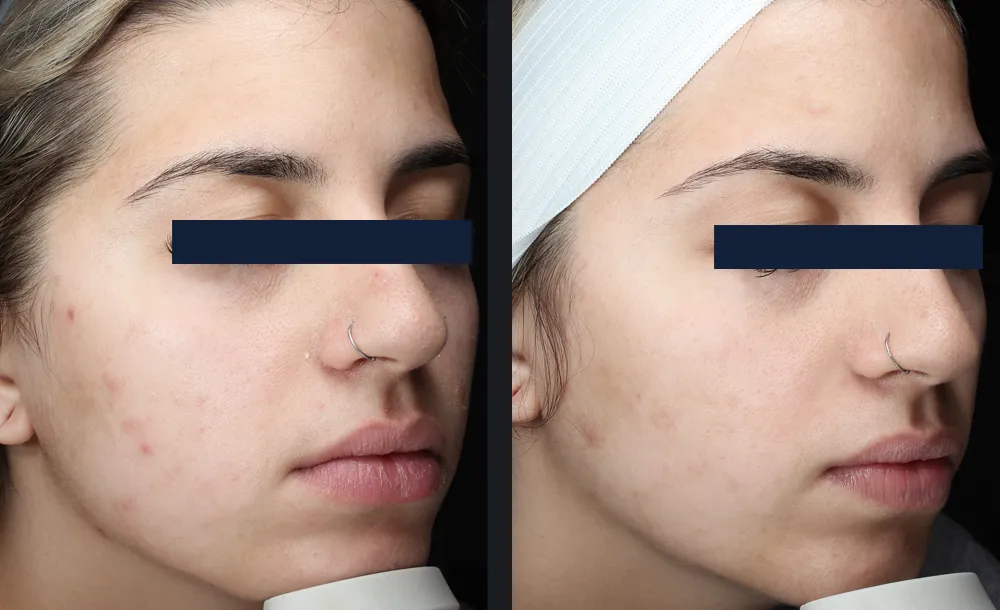 Glacé Hydrodermabrasion Tiefenreinigung Vorher-Nachher Ergebnis