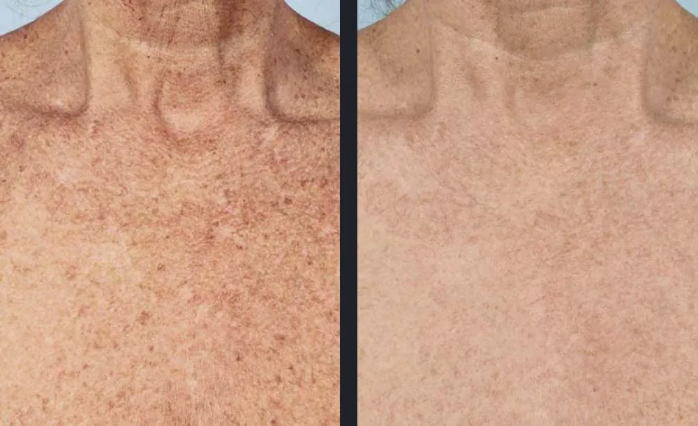 Candela Nordlys Lasertherapie klinisches Vorher-Nachher Ergebnis