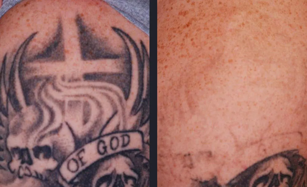 PicoWay Tattooentfernung Vorher Nachher Warendorf