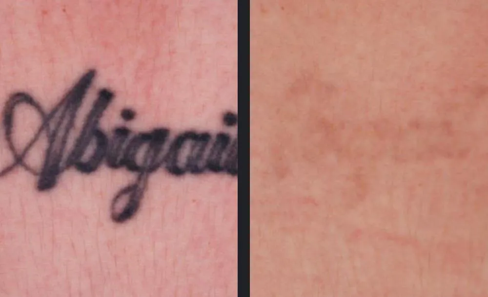 Candela PicoWay picosecond laser tattoo removal medical before and after result