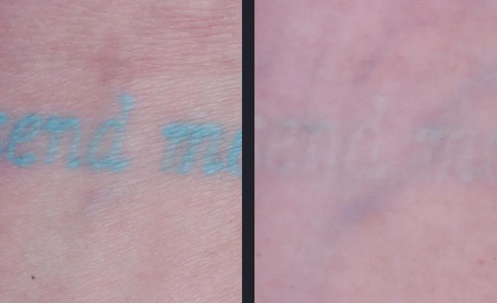 Candela PicoWay picosecond laser tattoo removal medical before and after result