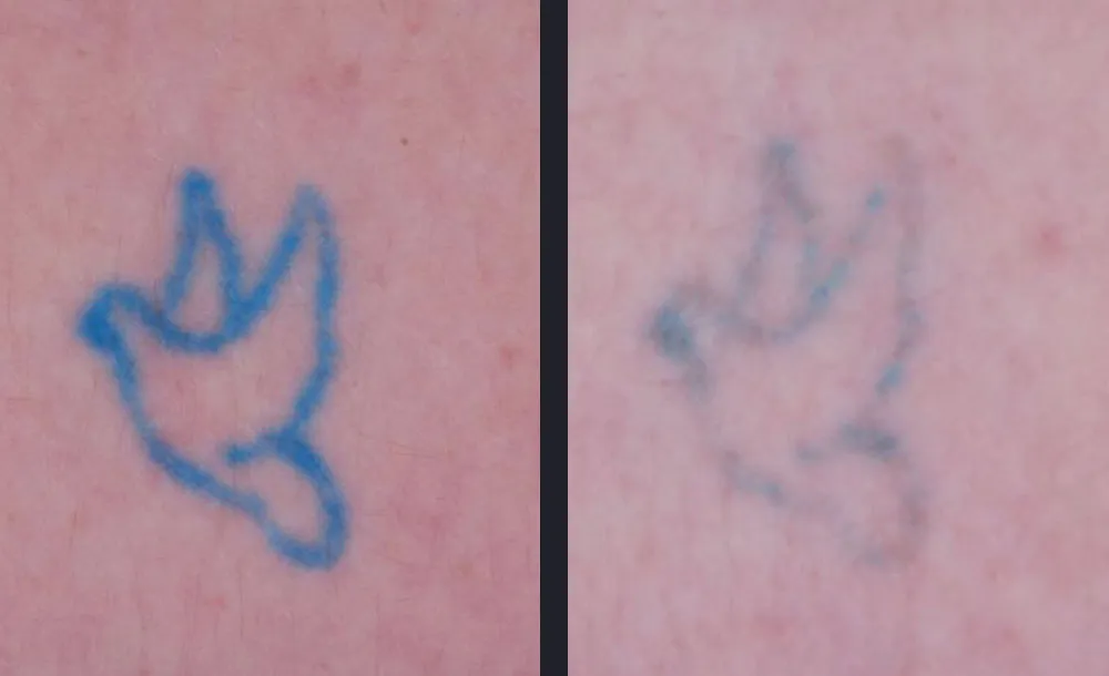Candela PicoWay picosecond laser tattoo removal medical before and after result
