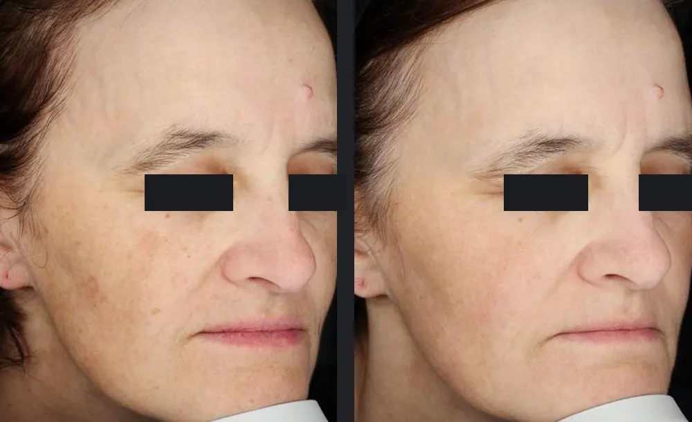 Candela PicoWay Pikosekundenlaser Pigmentbehandlung Vorher-Nachher Ergebnis