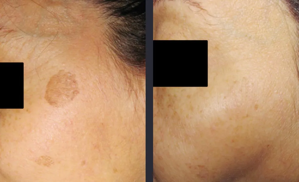 Candela PicoWay Pikosekundenlaser Pigmentbehandlung Vorher-Nachher Ergebnis