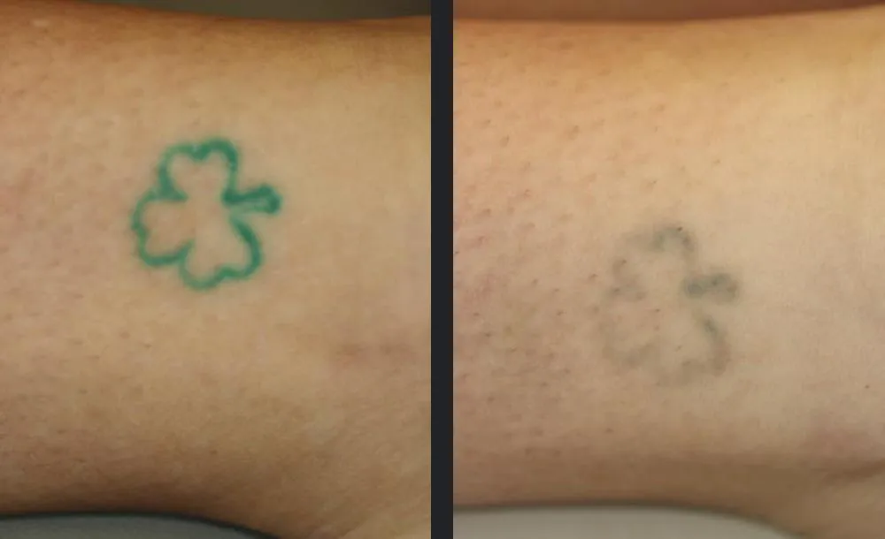 Patientenkomfort - PhilArt® Polynukleotide in Warendorf | Praxis AS Aesthetics Warendorf
