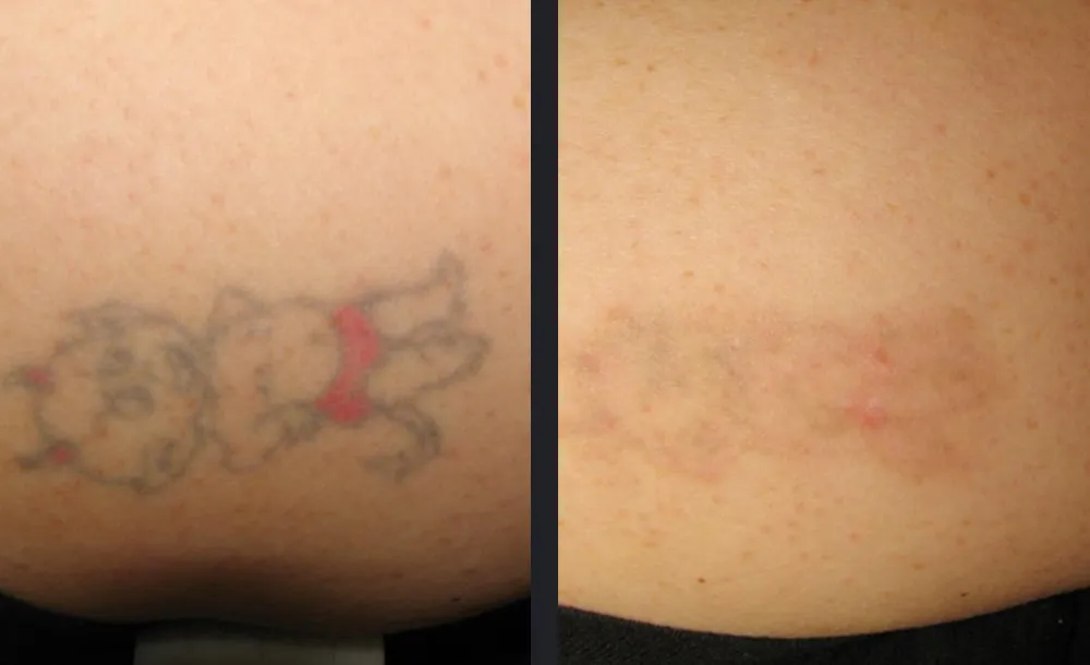 Candela PicoWay picosecond laser tattoo removal medical before and after result
