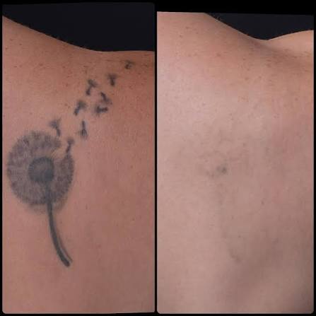 Candela PicoWay picosecond laser tattoo removal medical before and after result