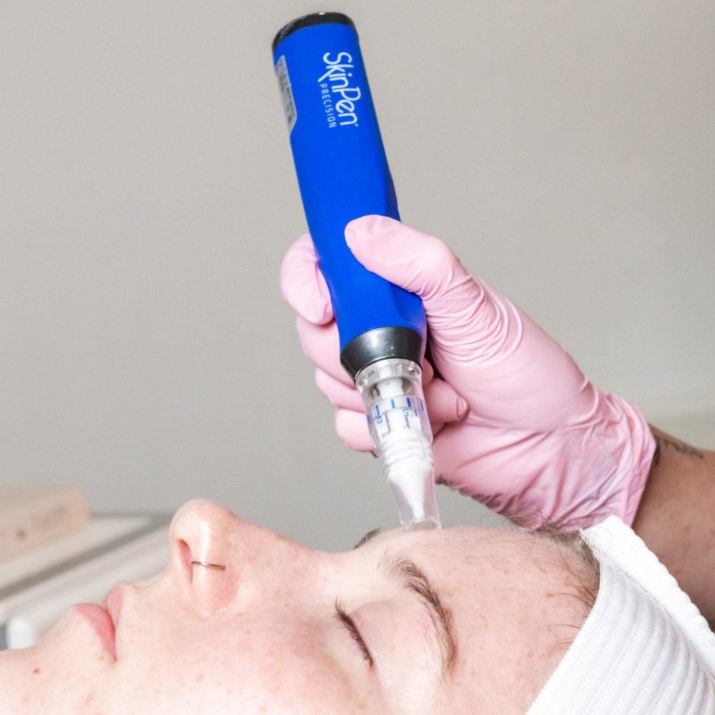 Lebensqualität - Tattooentfernung Warendorf | Tattoo Lasern & Pico Laser
