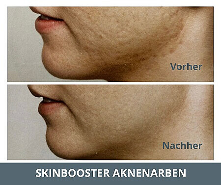 Nachher - Radiesse® Biostimulator in Warendorf | Praxis AS Aesthetics Warendorf