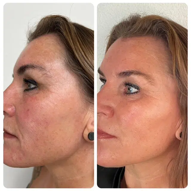 Klinische Präzision - Radiesse® Biostimulator in Warendorf | Praxis AS Aesthetics Warendorf