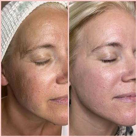 Klinisches Vorher-Nachher Ergebnis der Aknenarben-Behandlung mit SkinPen